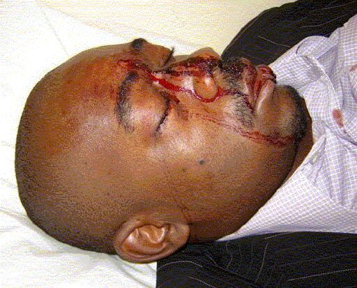 The battered face of Nelson Chamisa in post-2008 elections