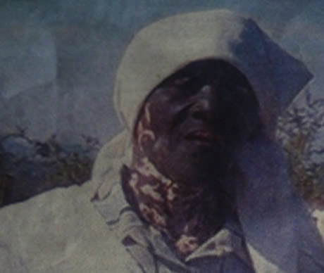 Epiphania Mabwinye’s skin started turning white five months ago