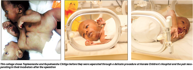the twin boys christened Kupakwashe and Tapiwanashe, were joined from the lower chest to the upper abdomen and shared a liver