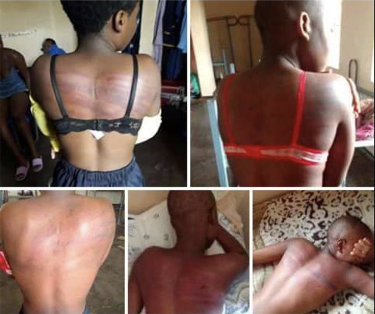 Some pupils at Chemhanza High School in Hwedza are nursing visible back injuries after allegedly being assaulted by the deputy head, with no details of the possible misconduct yet available.